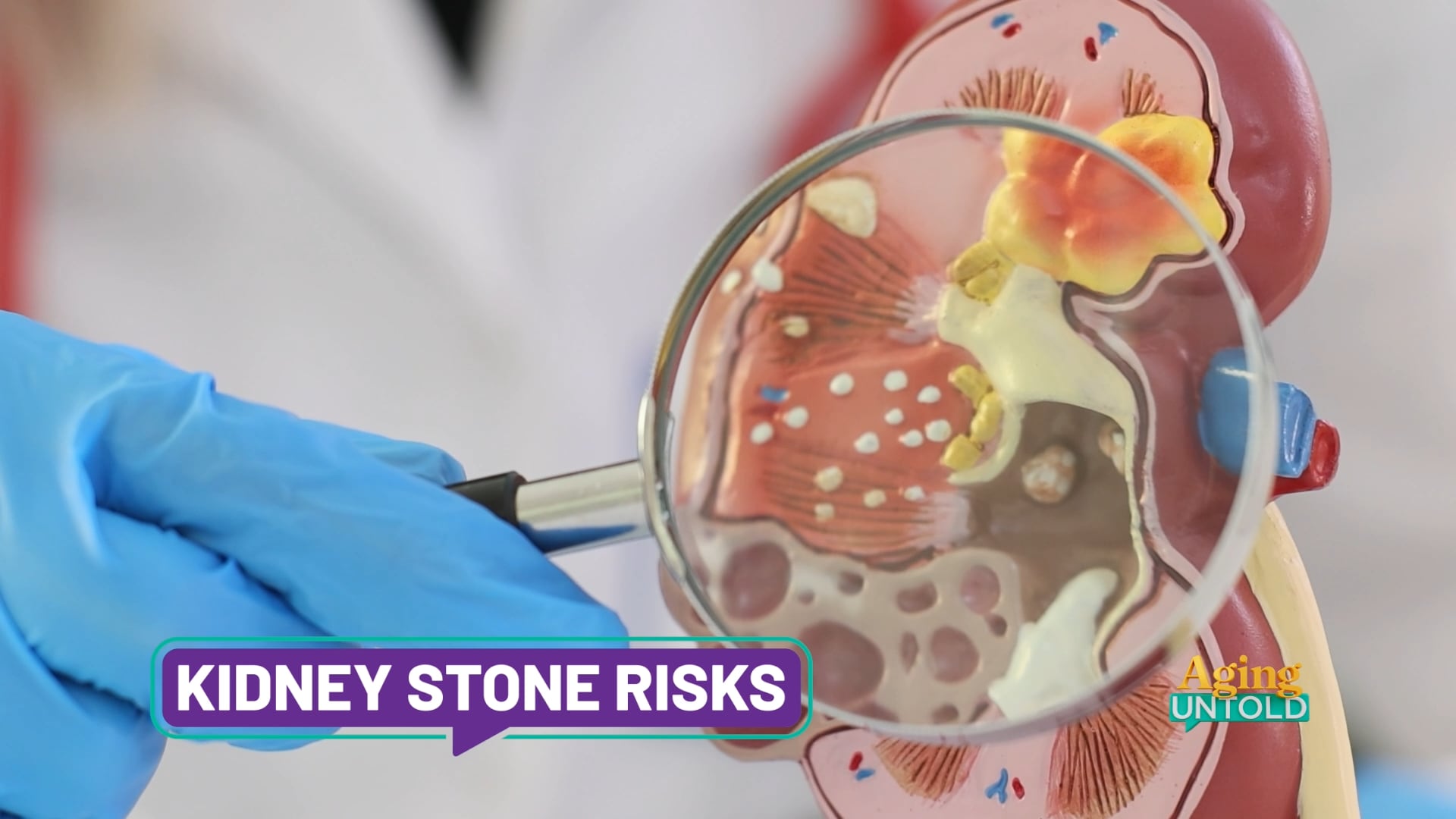 Understanding Kidney Stones: Causes, Symptoms, and Prevention Strategies