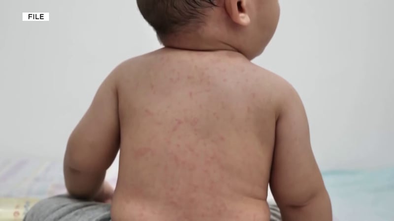 Arizona is experiencing its worst measles outbreak in decades, with 119 confirmed cases statewide