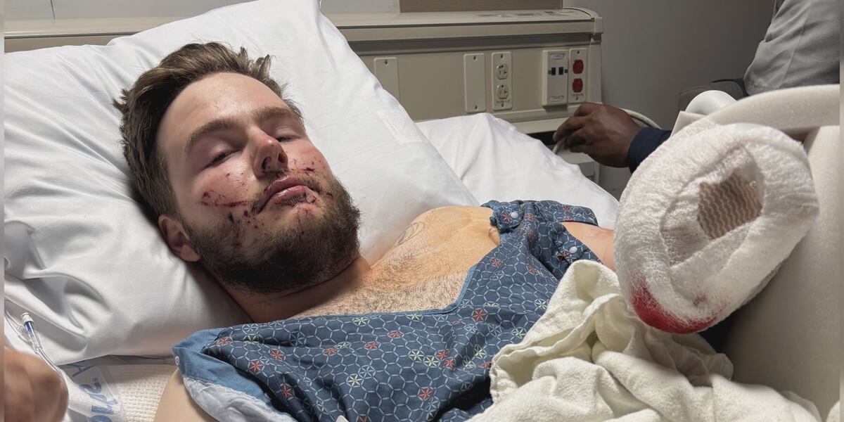 Recent high school grad at risk of losing his entire hand after a ...