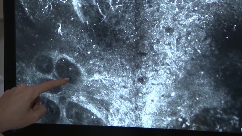 Melanoma is a very, very fast-moving cancer.