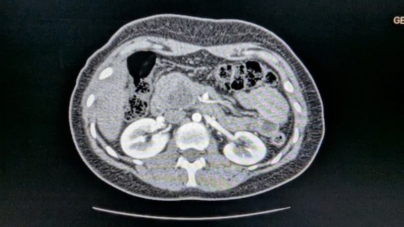 Doctors told Salls the Frantz tumor was non-cancerous but also malignant, because it was...