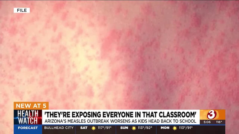Arizona’s measles outbreak is worsening as children head back to school, raising concerns...